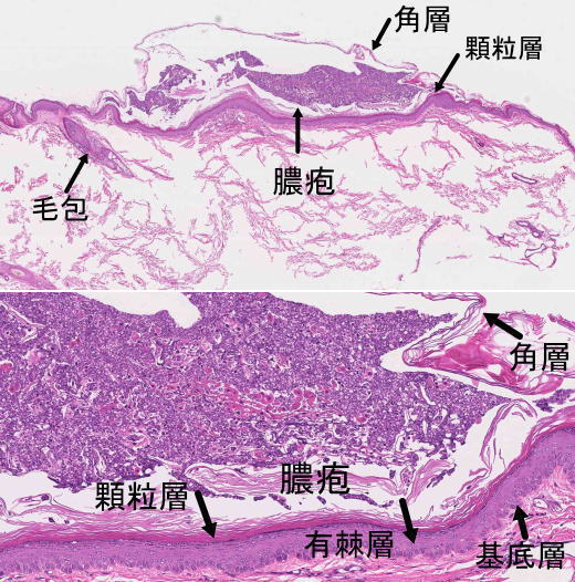 角層下膿疱症病理所見